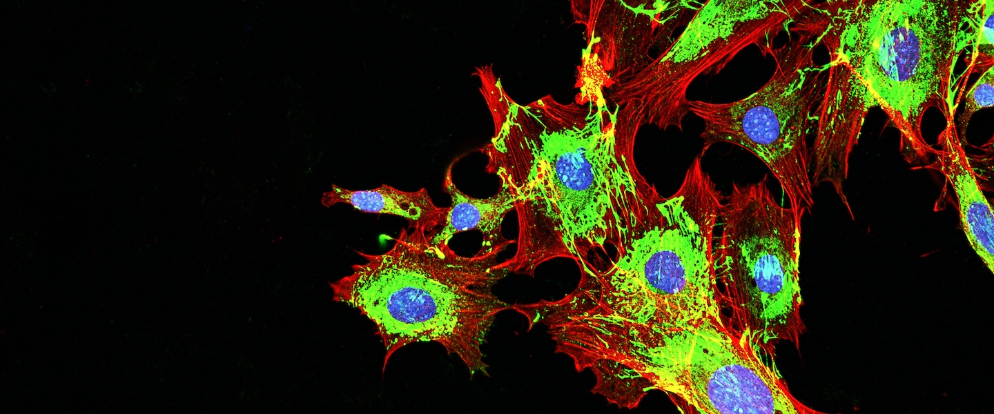 Microsope image of cancer cells, triple-fluorescent stained